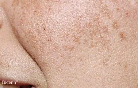 Primer plano de mejilla femenina con melasma