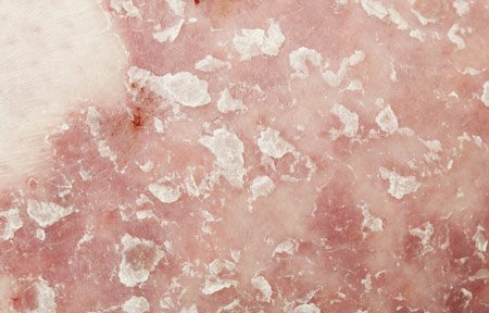 Atopichesky la dermatitis a los niños de la edad menor escolar