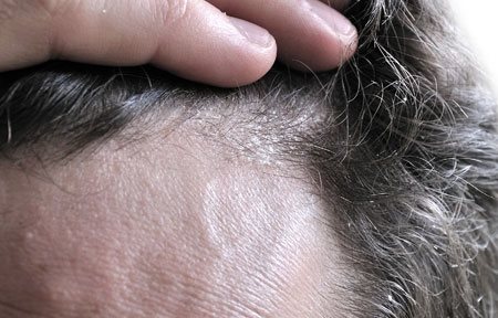 Las actas del tratamiento atopicheskogo de la dermatitis