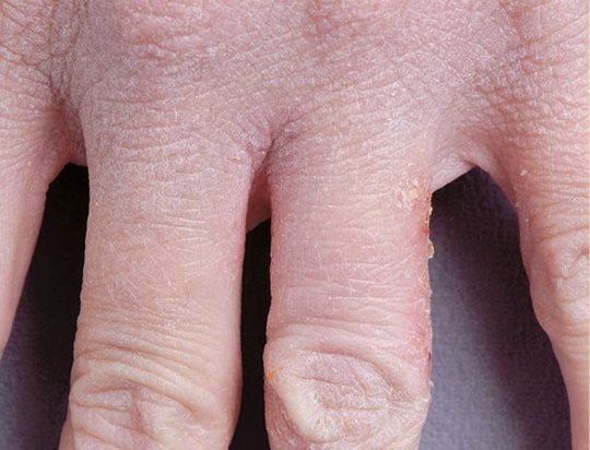 La psoriasis la agudización que quitar