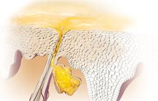 Los japoneses con la psoriasis
