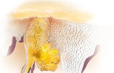 A la psoriasis es posible usar la crema infantil