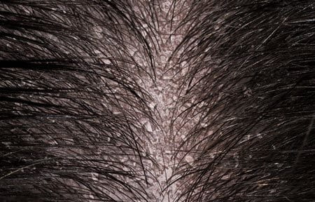Que es posible comer a atopicheskom la dermatitis al mamón