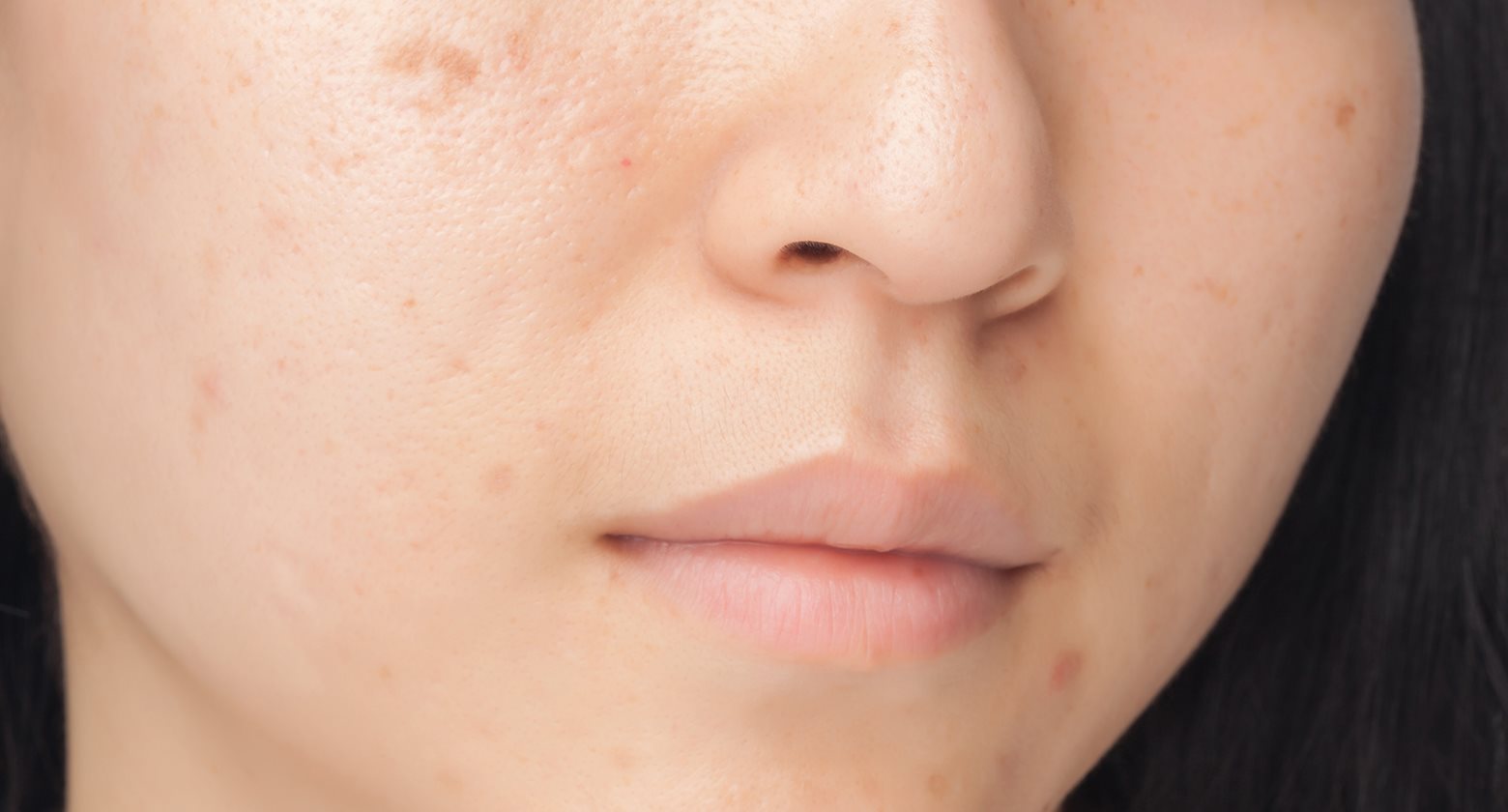 Marcas De Acne Las Consecuencias Del Acne Eucerin
