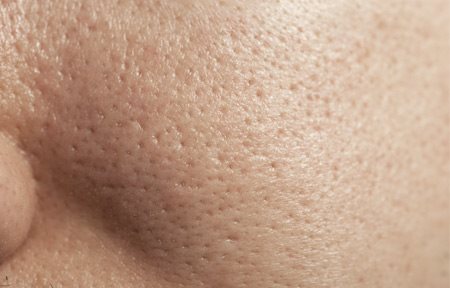 Como se librará de las manchas después de los granos sobre la persona del ungüento