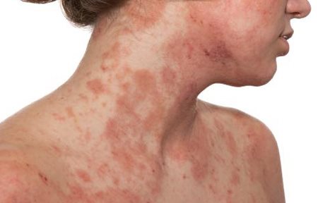 Puva la terapia para el tratamiento de la psoriasis el precio