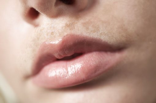 Primer plano de labio superior con hiperpigmentación